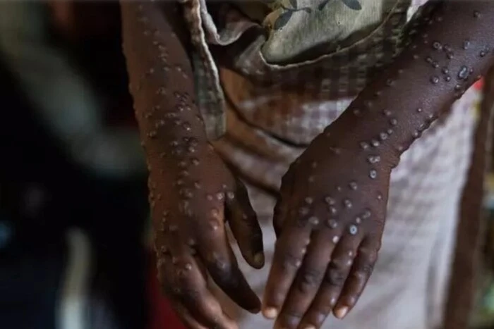 Critical situation with monkeypox outbreak in Congo